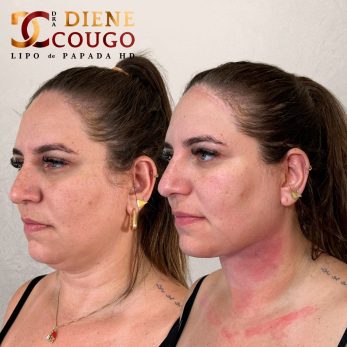 dra-diene-cougo-resultado-04.jpg
